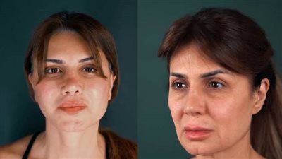لجأت لها نجلاء بدر وقبلها هيدي كرم.. اعرف سعر عملية شد الوجه