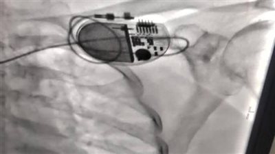 أطباء مستشفي منوف ينجحون فى تركيب جهاز منظم دائم للقلب لمسنة