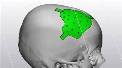 جراحة في المخ.. فريق طبي بملوي يُعيد طفلة للحياة بتقنية ثلاثية الأبعاد