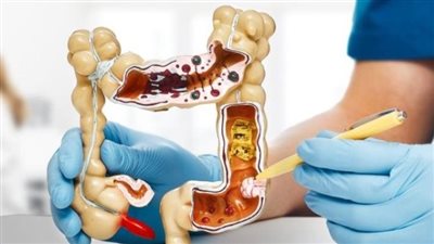 دراسة تكشف أسباب ارتفاع إصابات سرطان القولون بين الشباب