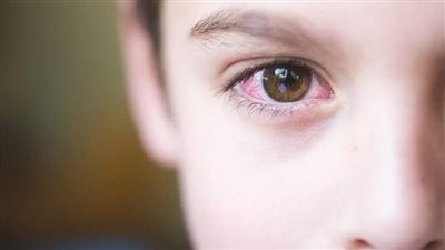 حافظي على عينيكي.. دليلك للوقاية من الرمد الربيعي وطرق العلاج 