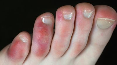 تورم إصبع القدم الكبير..تنبيه صحي قد يخفي مما تتخيل| اعرف الأسباب 