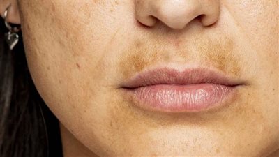 كيفية التخلص من الكلف حول الفم.. دليلكِ لاستعادة إشراقة بشرتكِ