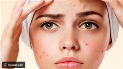 دراسة جديدة تكشف العلاقة بين أدوية التخسيس وحب الشباب 