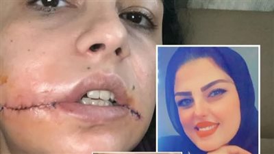 بعد تشويهه وجهها.. سيدة بورسعيدية تستغيث بالأجهزة الأمنية من طليقها