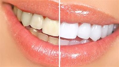 6 طرق طبيعية فعّالة في تبييض الأسنان .. منها زيت جوز الهند