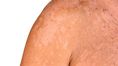 مع ارتفاع الحرارة.. التينيا تنتشر صيفًا وطبيب يوضح أسبابها وطرق الوقاية