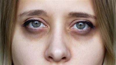 أسباب الهالات السوداء عند الأطفال.. متى تكون علامة خطر ؟